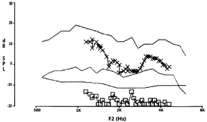 otoacoustic-emissions-and-the-standard-audiological-test-battery_0.jpeg