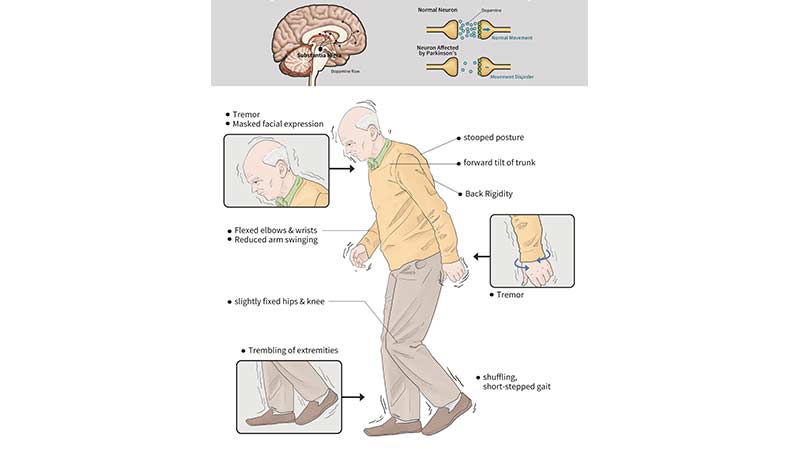 postural-instability_0.jpeg